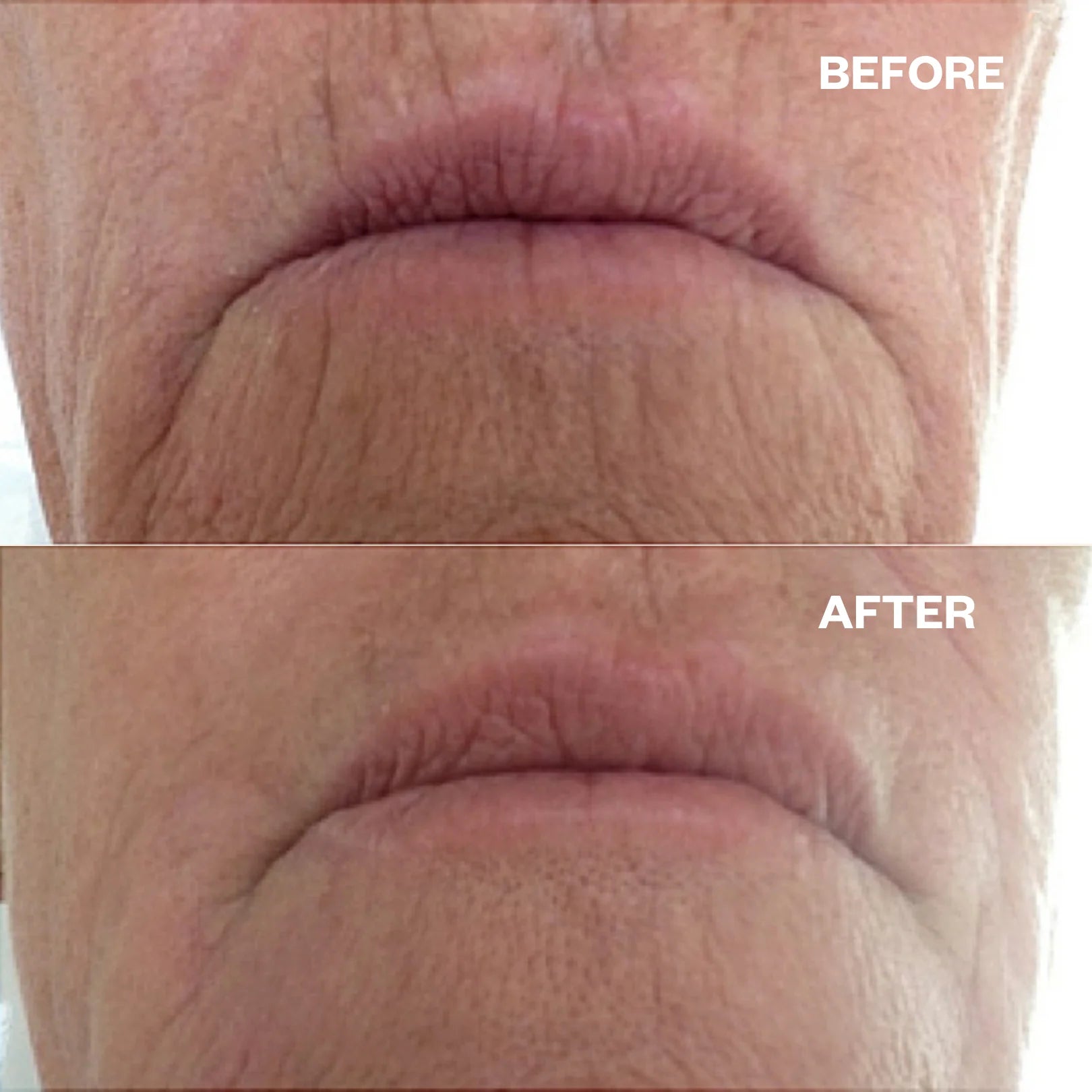 Wrinkles Schminkles Mouth & Lip Patches